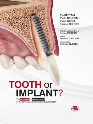 cover image of Tooth or Implant?